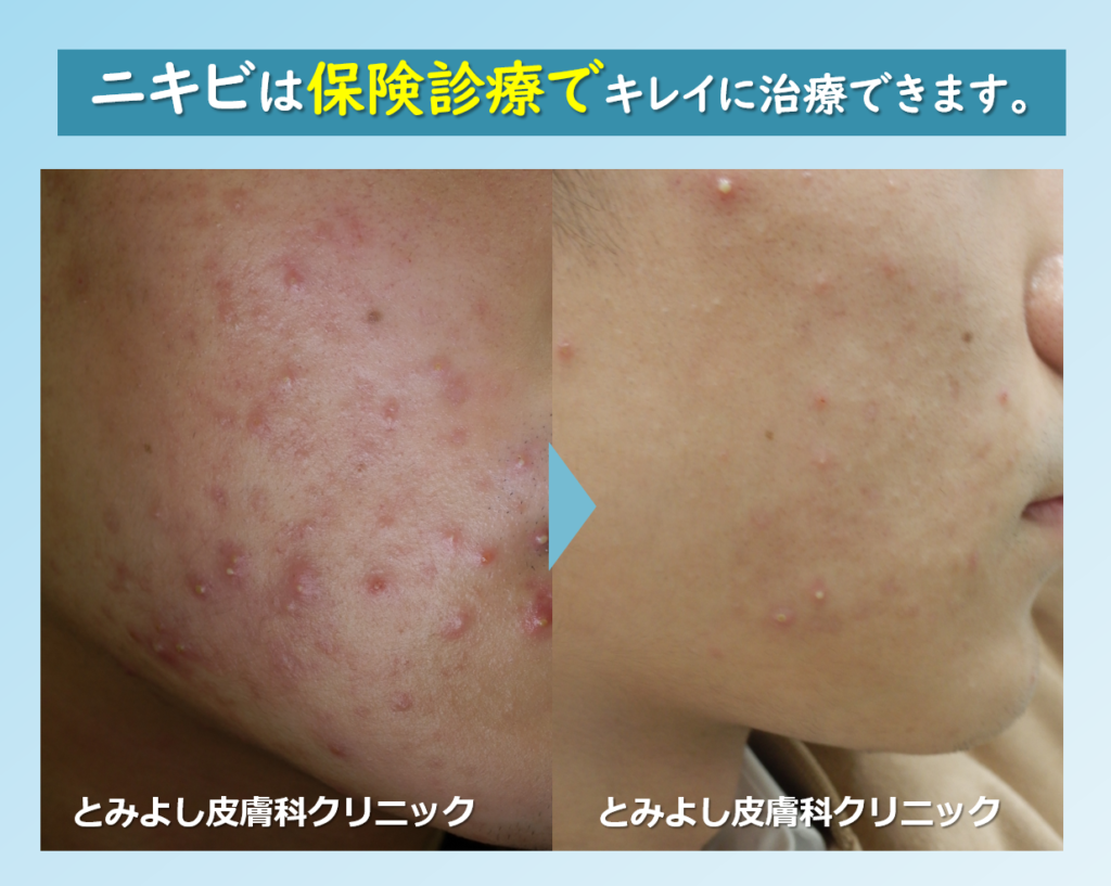 ニキビ治療